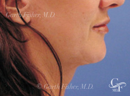 Photo of Patient 08 After Neck Lift