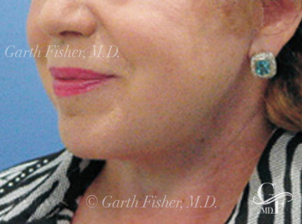 Photo of Patient 09 After Neck Lift