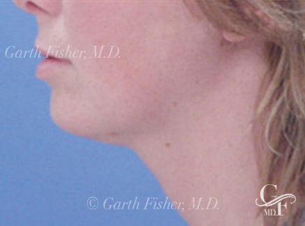 Photo of Patient 10 After Neck Lift