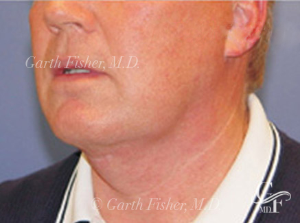 Photo of Patient 11 After Neck Lift