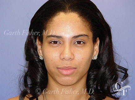 Photo of Patient 02 After Ethnic Rhinoplasty