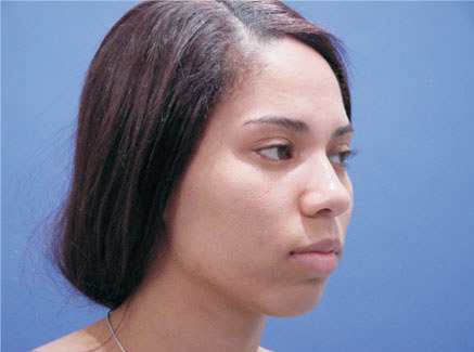 Photo of Patient 02 Before Ethnic Rhinoplasty