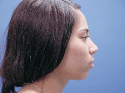 Photo of Patient 02 Before Ethnic Rhinoplasty