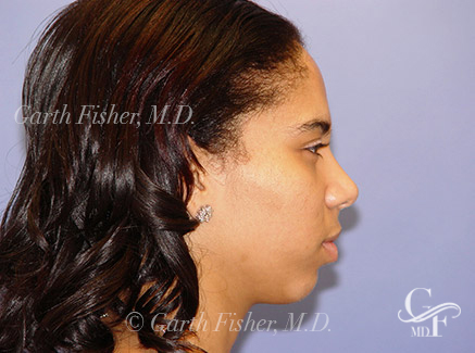 Photo of Patient 02 After Ethnic Rhinoplasty