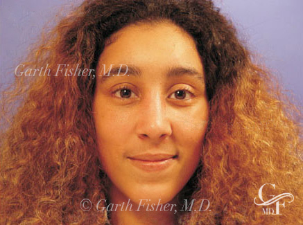 Photo of Patient 03 After Ethnic Rhinoplasty