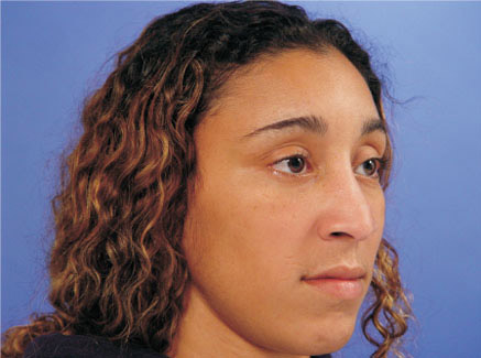 Photo of Patient 03 Before Ethnic Rhinoplasty