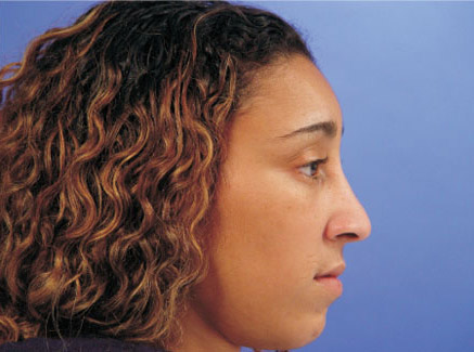 Photo of Patient 03 Before Ethnic Rhinoplasty