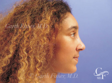 Photo of Patient 03 After Ethnic Rhinoplasty