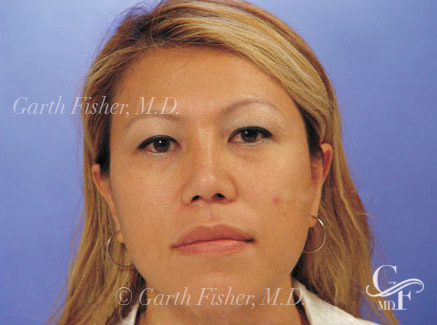 Photo of Patient 04 After Ethnic Rhinoplasty