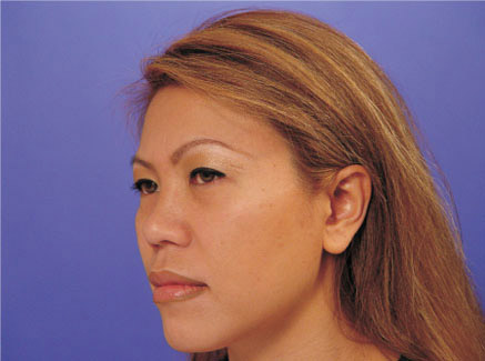 Photo of Patient 04 Before Ethnic Rhinoplasty