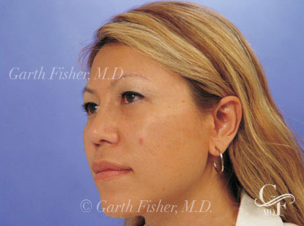 Photo of Patient 04 After Ethnic Rhinoplasty