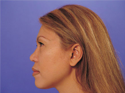 Photo of Patient 04 Before Ethnic Rhinoplasty