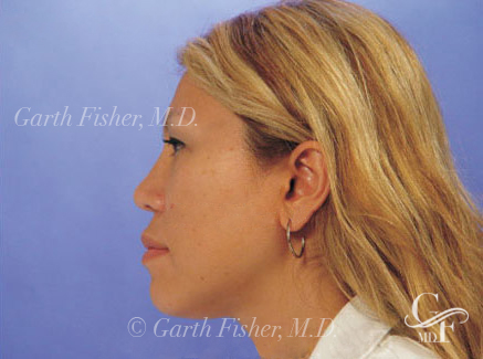 Photo of Patient 04 After Ethnic Rhinoplasty