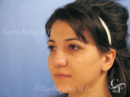 Photo of Patient 01 After Primary Rhinoplasty