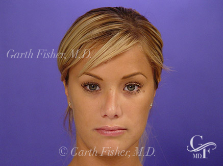 Photo of Patient 03 After Primary Rhinoplasty
