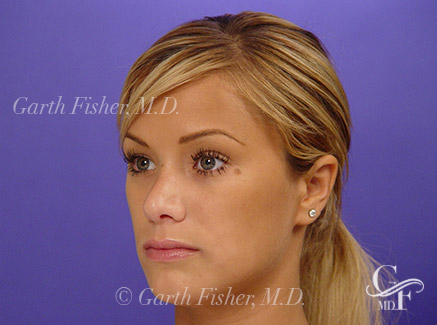 Photo of Patient 03 After Primary Rhinoplasty