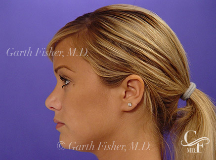 Photo of Patient 03 After Primary Rhinoplasty