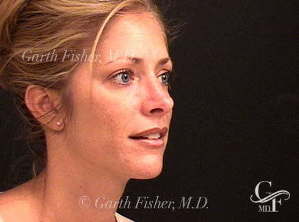 Photo of Patient 04 After Primary Rhinoplasty