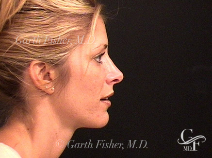 Photo of Patient 04 After Primary Rhinoplasty