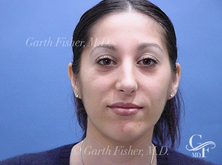 Photo of Patient 05 After Primary Rhinoplasty