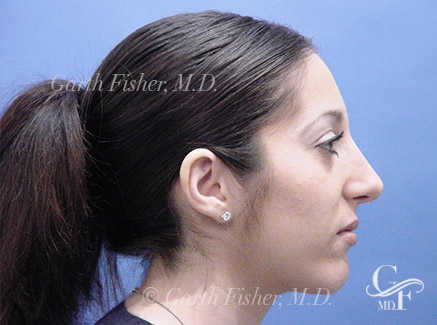 Photo of Patient 05 After Primary Rhinoplasty