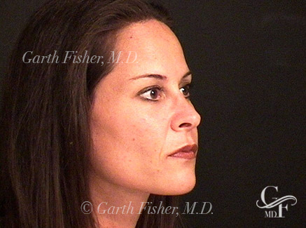 Photo of Patient 06 After Primary Rhinoplasty