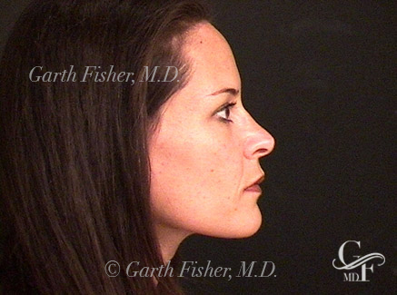 Photo of Patient 06 After Primary Rhinoplasty