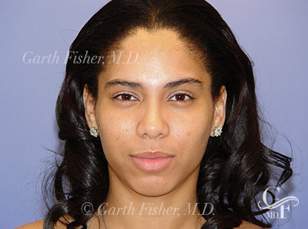 Photo of Patient 07 After Primary Rhinoplasty