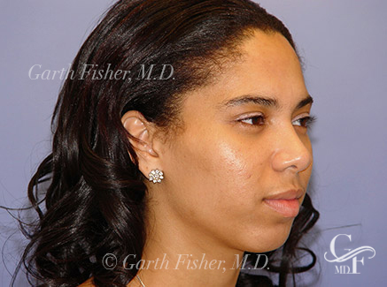 Photo of Patient 07 After Primary Rhinoplasty