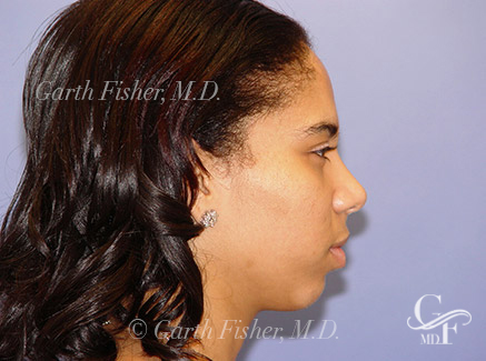 Photo of Patient 07 After Primary Rhinoplasty