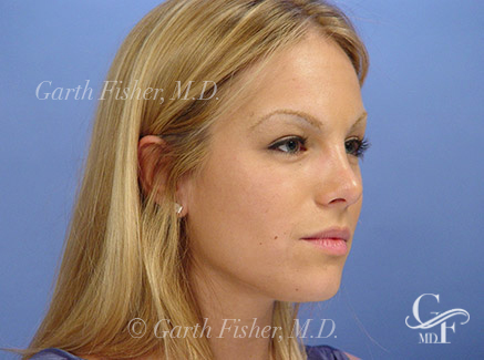 Photo of Patient 08 After Primary Rhinoplasty