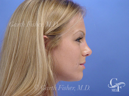 Photo of Patient 08 After Primary Rhinoplasty