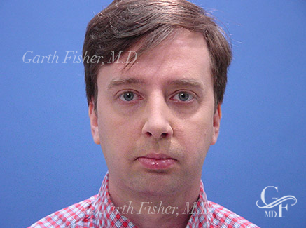 Photo of Patient 10 After Primary Rhinoplasty