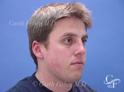 Photo of Patient 11 After Primary Rhinoplasty