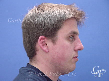 Photo of Patient 11 After Primary Rhinoplasty