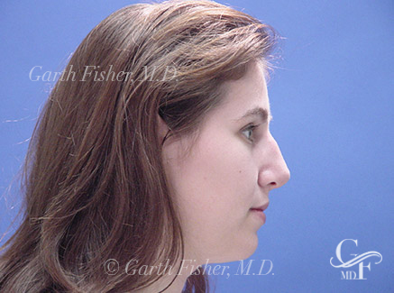 Photo of Patient 12 After Primary Rhinoplasty