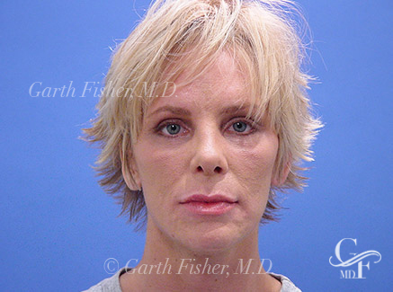 Photo of Patient 13 After Primary Rhinoplasty