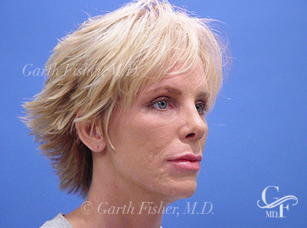 Photo of Patient 13 After Primary Rhinoplasty
