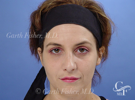 Photo of Patient 14 After Primary Rhinoplasty