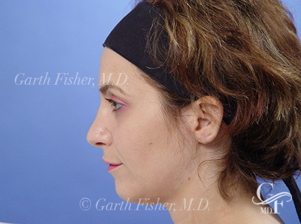 Photo of Patient 14 After Primary Rhinoplasty