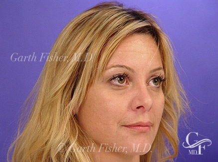 Photo of Patient 15 After Primary Rhinoplasty