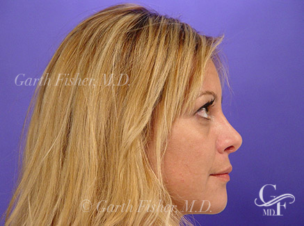 Photo of Patient 15 After Primary Rhinoplasty