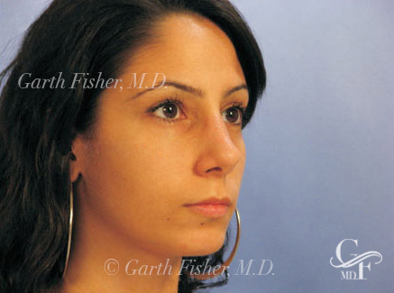 Photo of Patient 17 After Primary Rhinoplasty