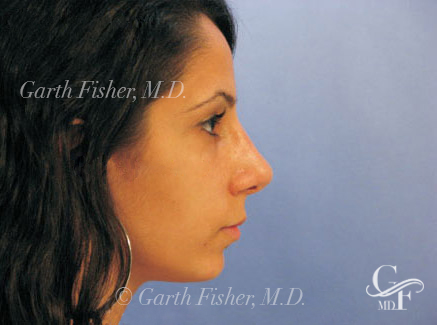 Photo of Patient 17 After Primary Rhinoplasty