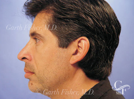Photo of Patient 18 After Primary Rhinoplasty