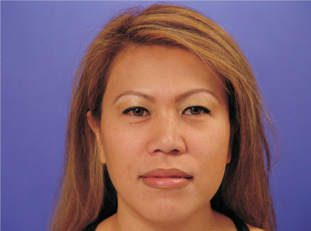 Photo of Patient 19 Before Primary Rhinoplasty