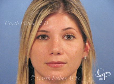Photo of Patient 20 After Primary Rhinoplasty