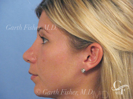 Photo of Patient 20 After Primary Rhinoplasty