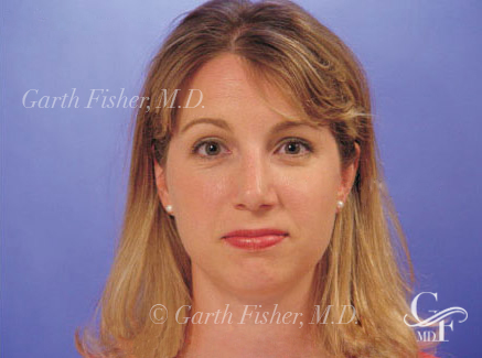 Photo of Patient 21 After Primary Rhinoplasty