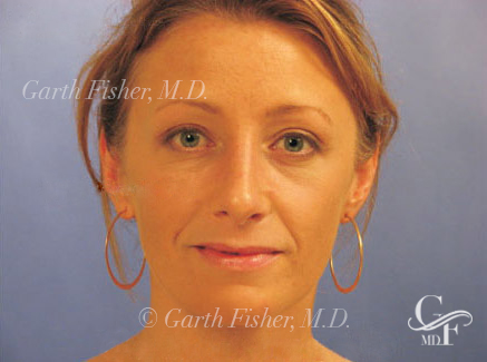 Photo of Patient 22 After Primary Rhinoplasty
